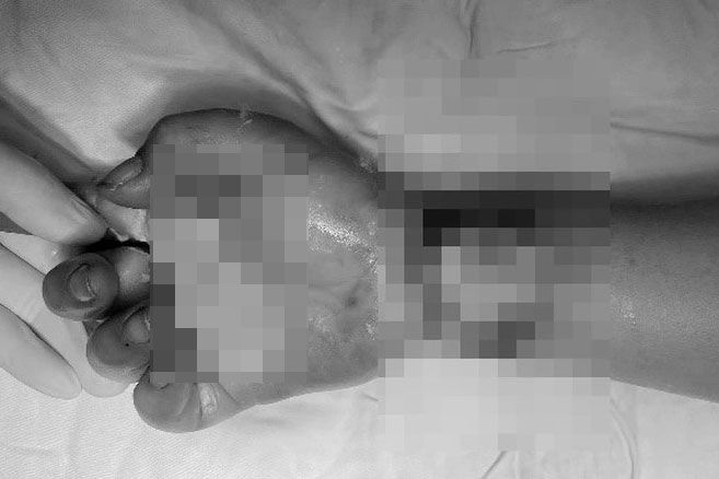 Ms. Nguyen Thi H. suffered severe burns due to electric shock while erecting the Neu tree to welcome Tet. Photo: Tu Thanh