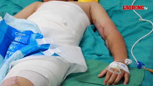 Initial first aid when injured helps minimize complications for patients. Photo: Nguyen Ly