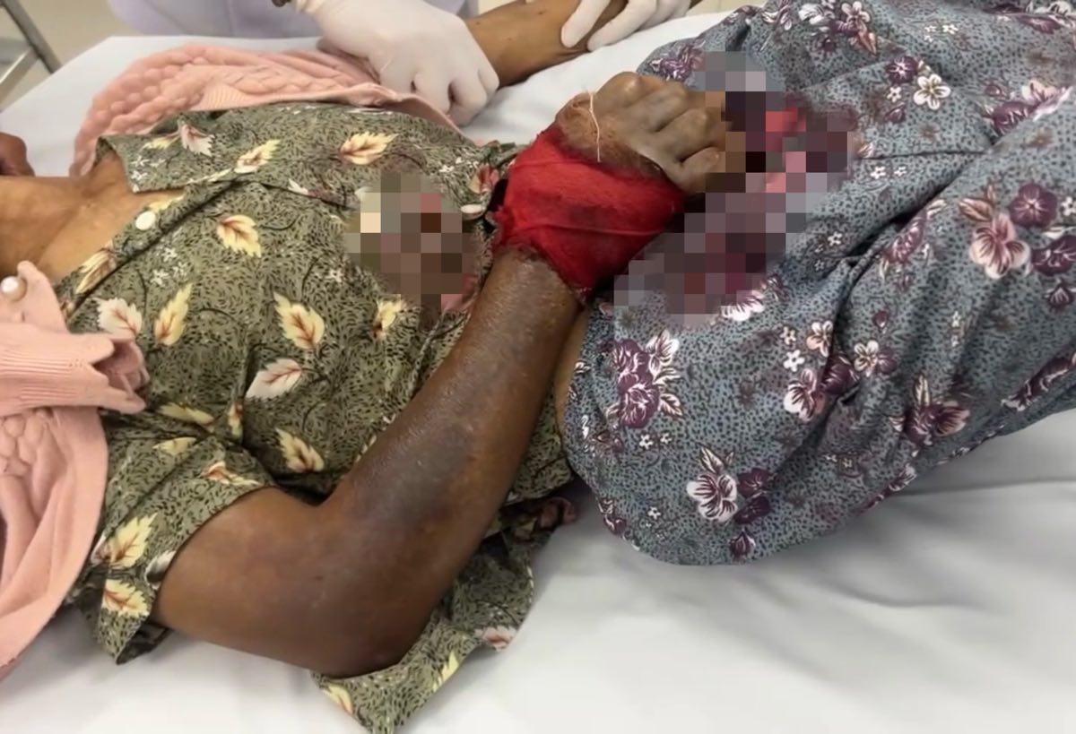 Tay nạn nhân trong tình trạng tím đen khi đến bệnh viện. Ảnh: Duy Tuấn