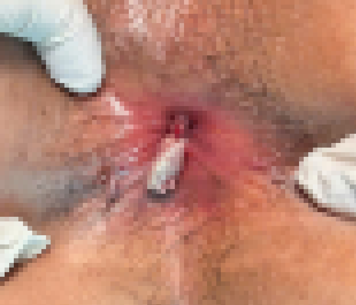 Patients with genital warts, appearing papillomas in the intimate area. Photo: BVCC