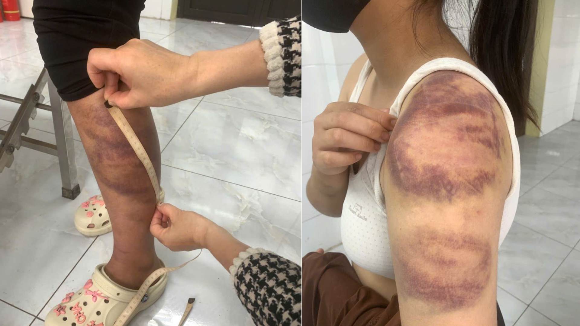 Những vết bầm tím trên cơ thể cháu T. do bị bố đẻ đánh. Ảnh: Công an Bắc Ninh

