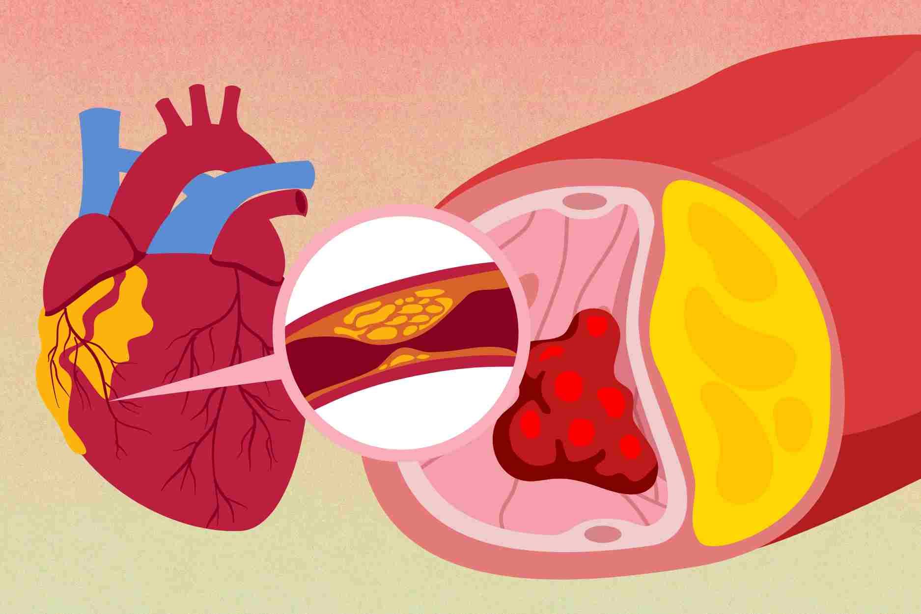 3 groups of foods silently destroying arteries