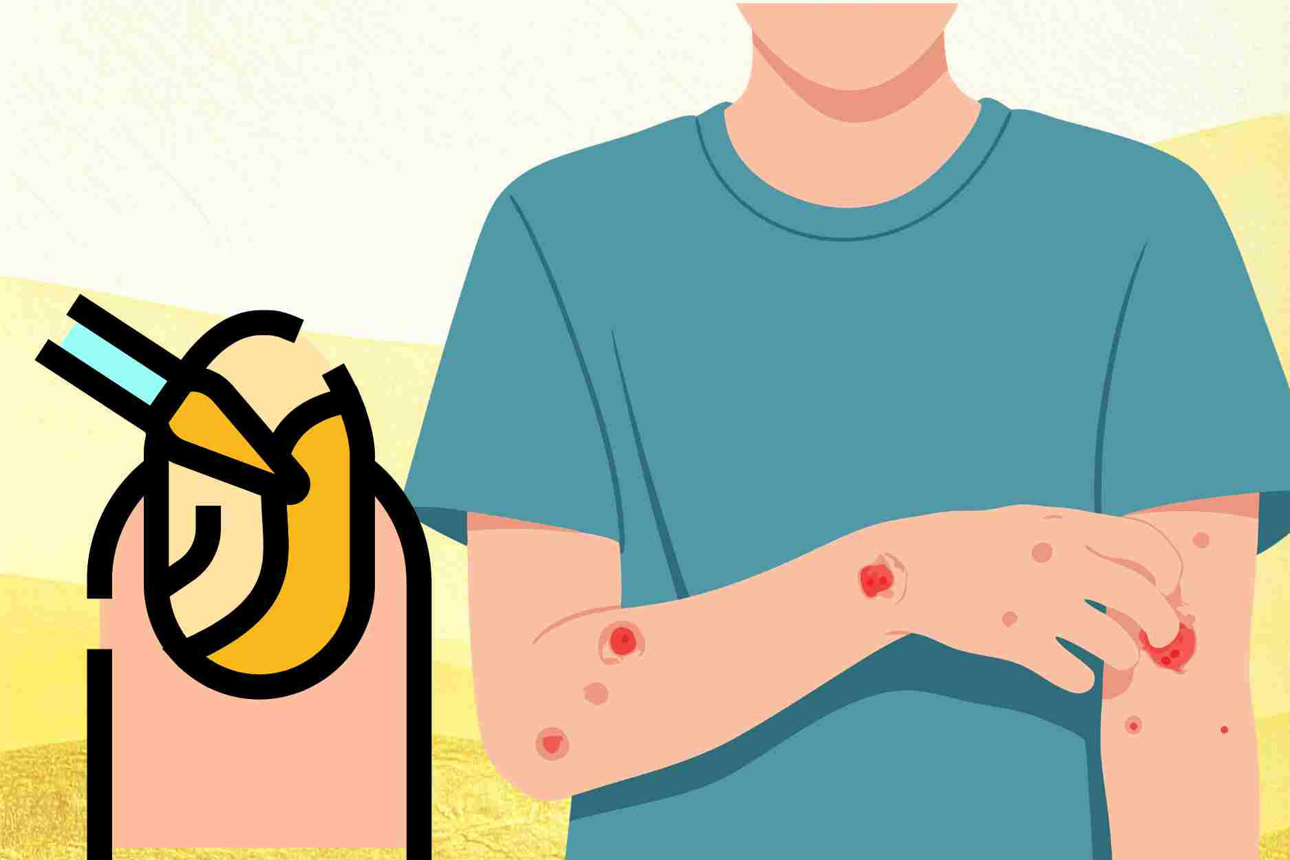 3 skin diseases caused by bacteria and fungi that easily break out when the weather is humid