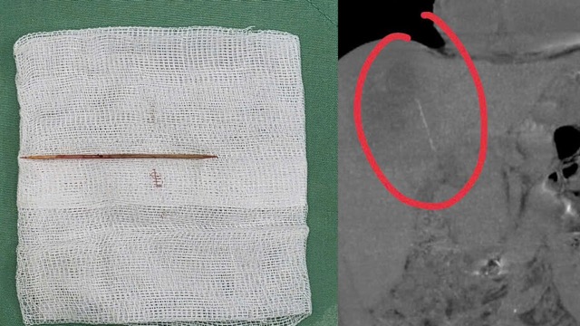 The toothpick located in the liver caused the patient to have a deep abscess complication and was taken out by the doctor in time. Photo: BVCC