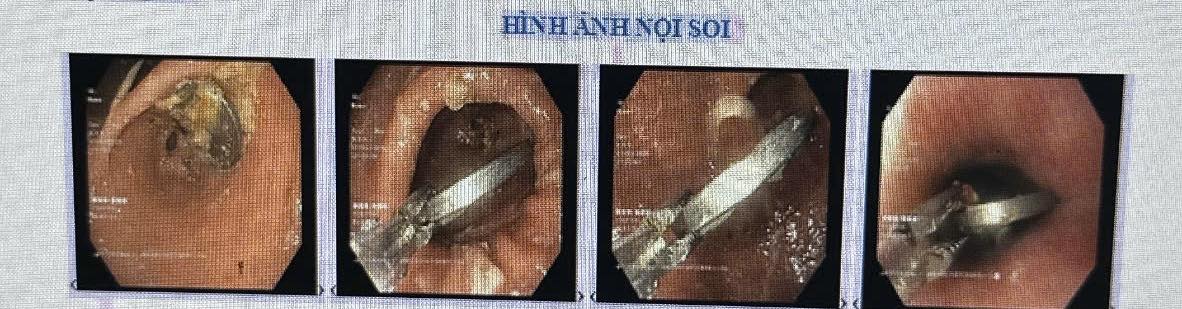 Hình ảnh nội soi. Ảnh: Bệnh viện Sản - Nhi tỉnh Quảng Ngãi