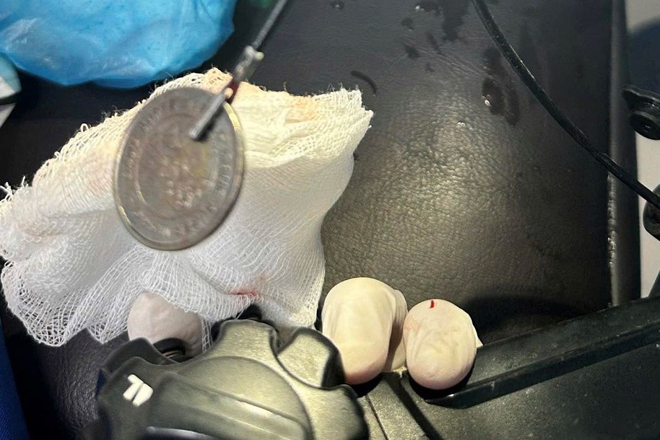 The foreign object was removed from the baby's esophagus. Photo: Quang Ngai Provincial Obstetrics and Pediatrics Hospital