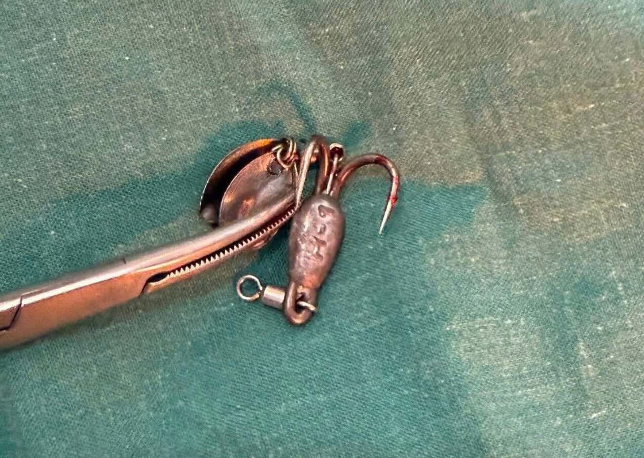 La langue de pêche a été retirée par les médecins du cou d'un enfant de 13 ans. Photo: Hôpital général régional de Bắc Quảng Trị