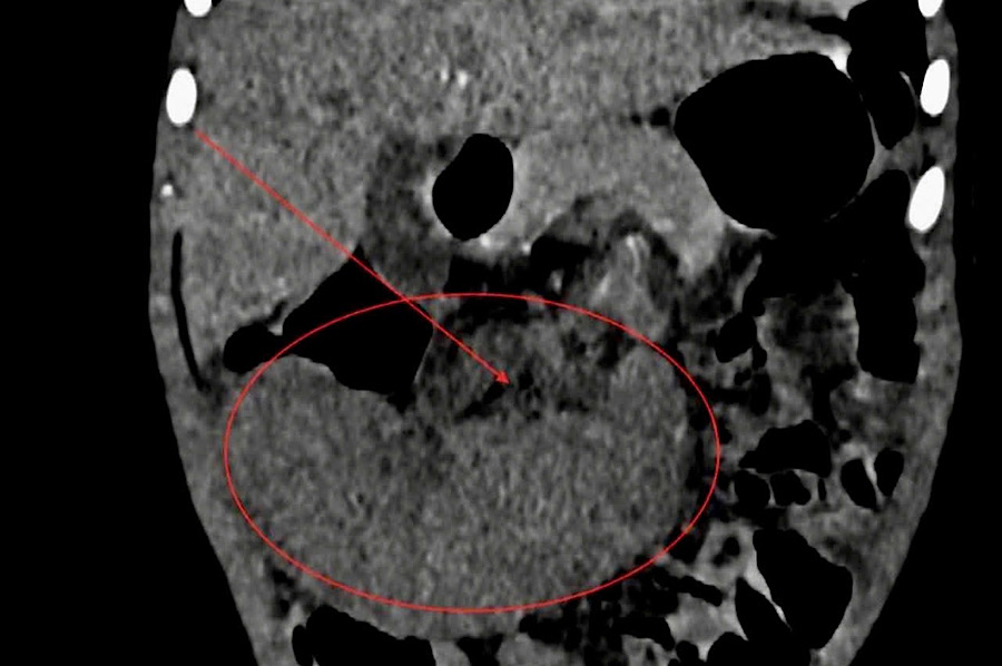 Endoscopic surgery to treat scoliosis is rare in children aged 40 months. Photo: Vietnam - Cuba Dong Hoi Friendship Hospital