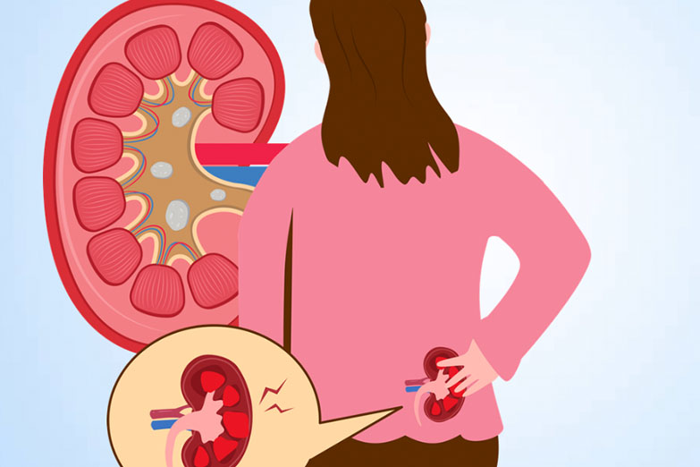 Women's kidneys can be silently damaged by daily habits. Graphics: Thien Nhan