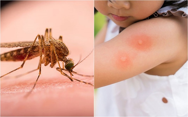 The insect bites seem small but can cause severe allergies, even dangerous anaphylactic shock. Photo AI