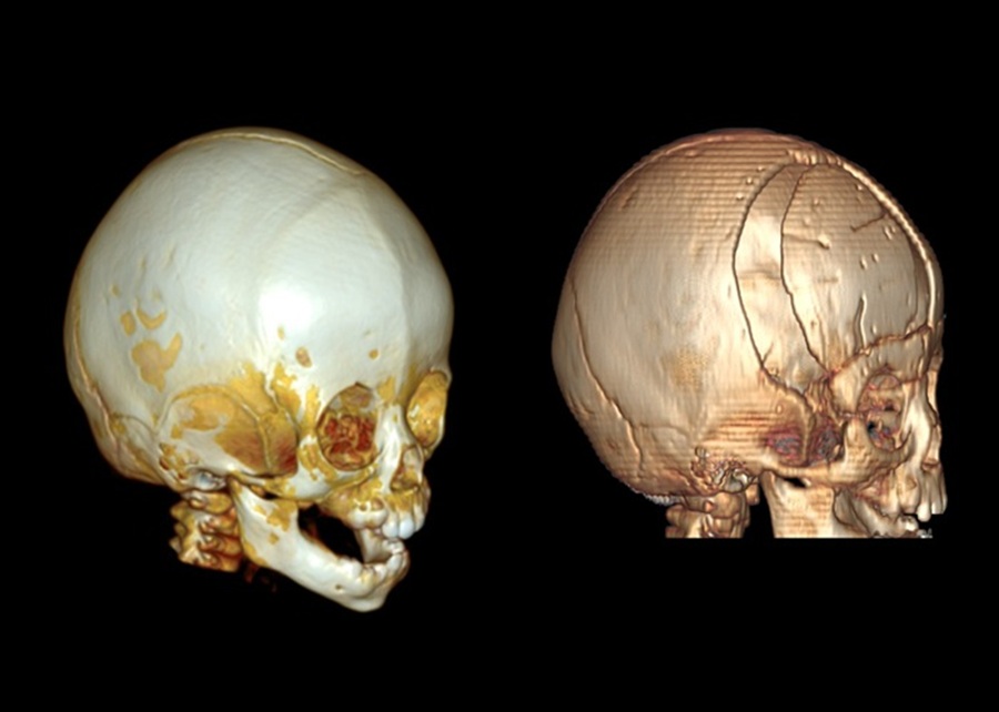 Phim chụp cắt lớp dựng hình 3D trước phẫu thuật (bên trái) và sau phẫu thuật (bên phải) của bé M.T.