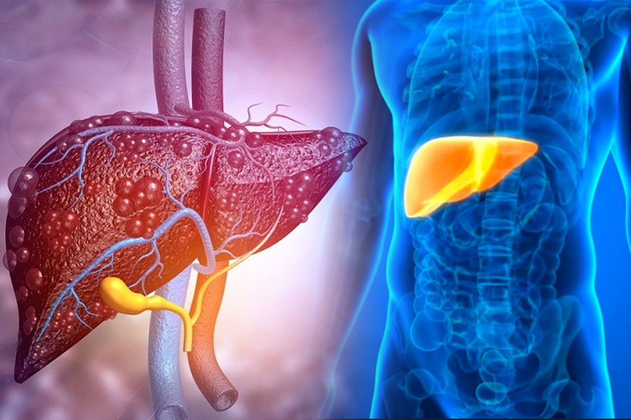 Doctors warn of seemingly harmless habits that increase the risk of fatty liver