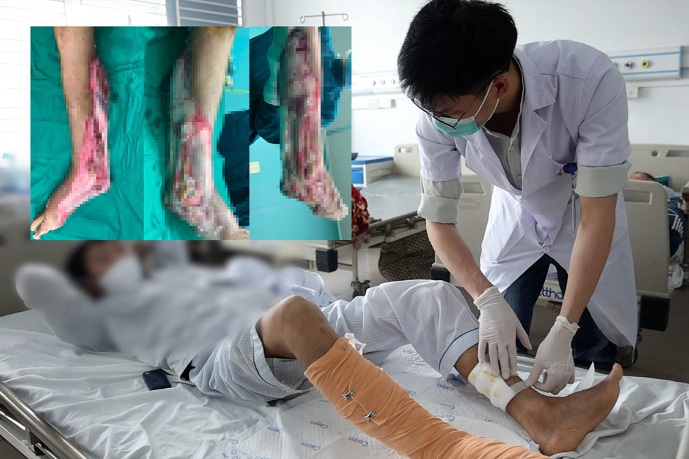 Self-treating electric burns with leaves, man has foot necrosis