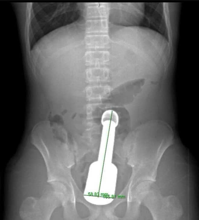 Hình ảnh phim chụp X. quang cho bệnh nhân. Ảnh: BVCC