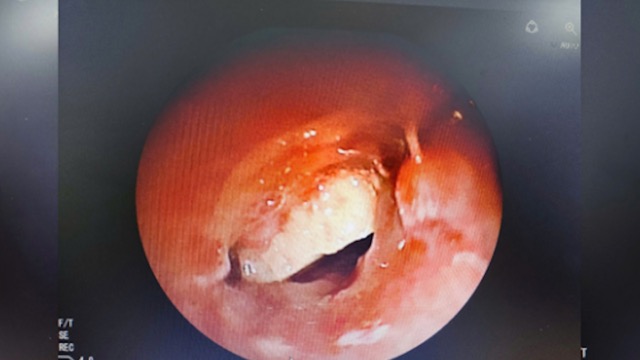 Image of almonds trapped in the patient's bronchi. Photo: BVCC