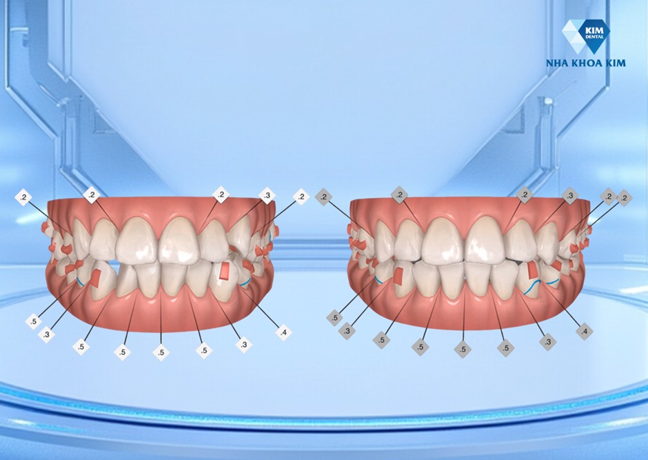 Công nghệ AI mô phỏng giúp nhìn thấy trước kết quả sau khi niềng răng tại Nha Khoa Kim. Ảnh: Nha Khoa Kim