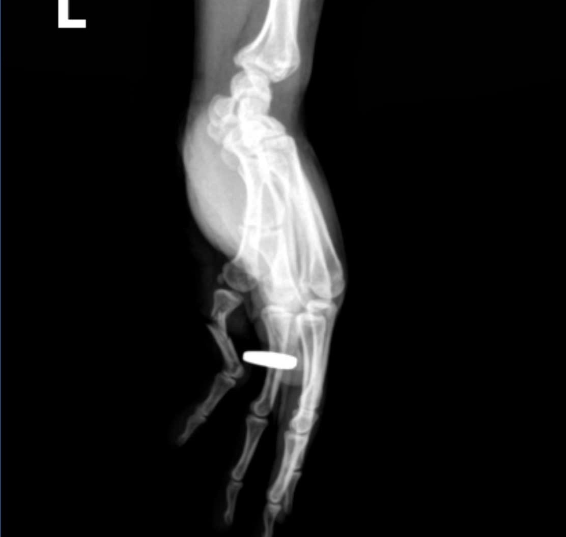 Timely emergency treatment for open finger fracture due to traffic accident. Photo: BVCC