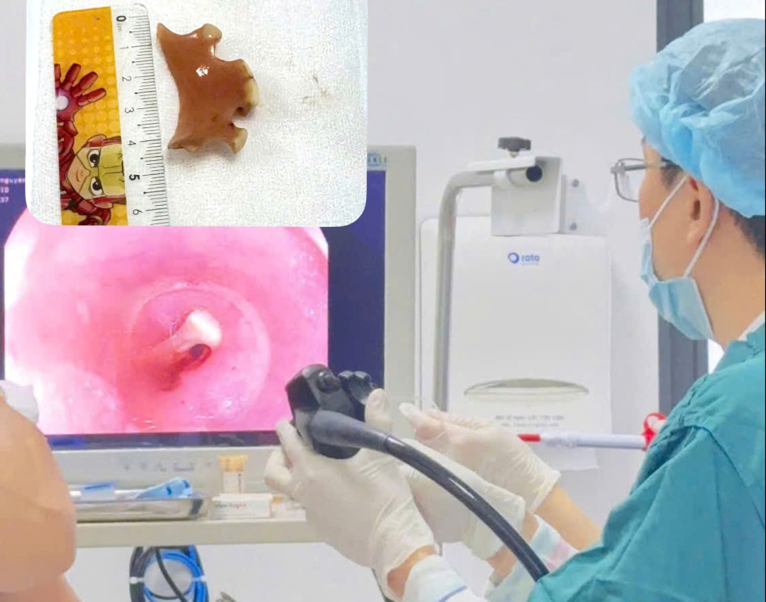 Doctors and nurses proceed to remove the foreign object, which is a set of dentures, from a patient's esophagus in Khanh Hoa. Photo: Hospital 22-12