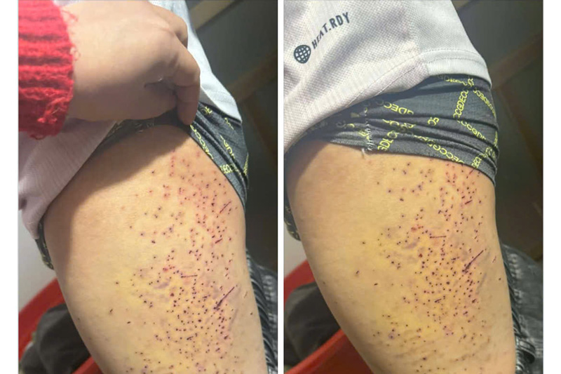 Images claiming that a student at Mau A Secondary School, Lao Cai province was injured by a friend using a sharp object. Photo: People provided