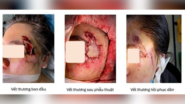 Patient successfully receives skin graft. Photo: BVCC