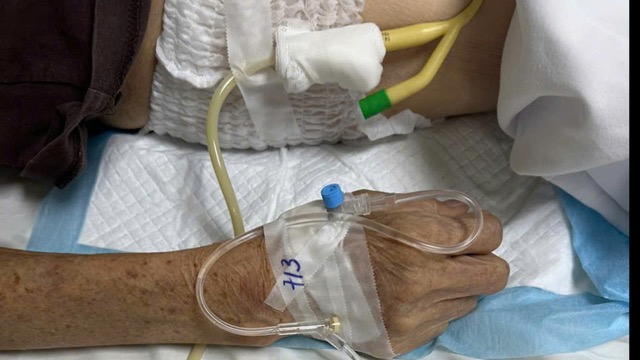 Patient with urinary tract infection causing urine to be milky white. Photo: Nguyen Ly