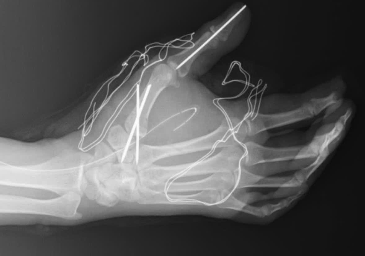 Các vị trí xương gãy và khớp bị trật cũng được cố định để ổn định cấu trúc bàn tay. Ảnh: Hạnh Thơm