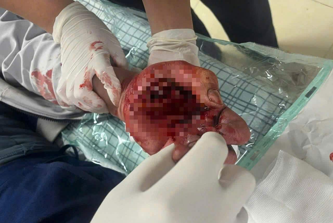 Accident in an instant: Young man almost loses hand due to firecracker explosion. Photo: BVCC