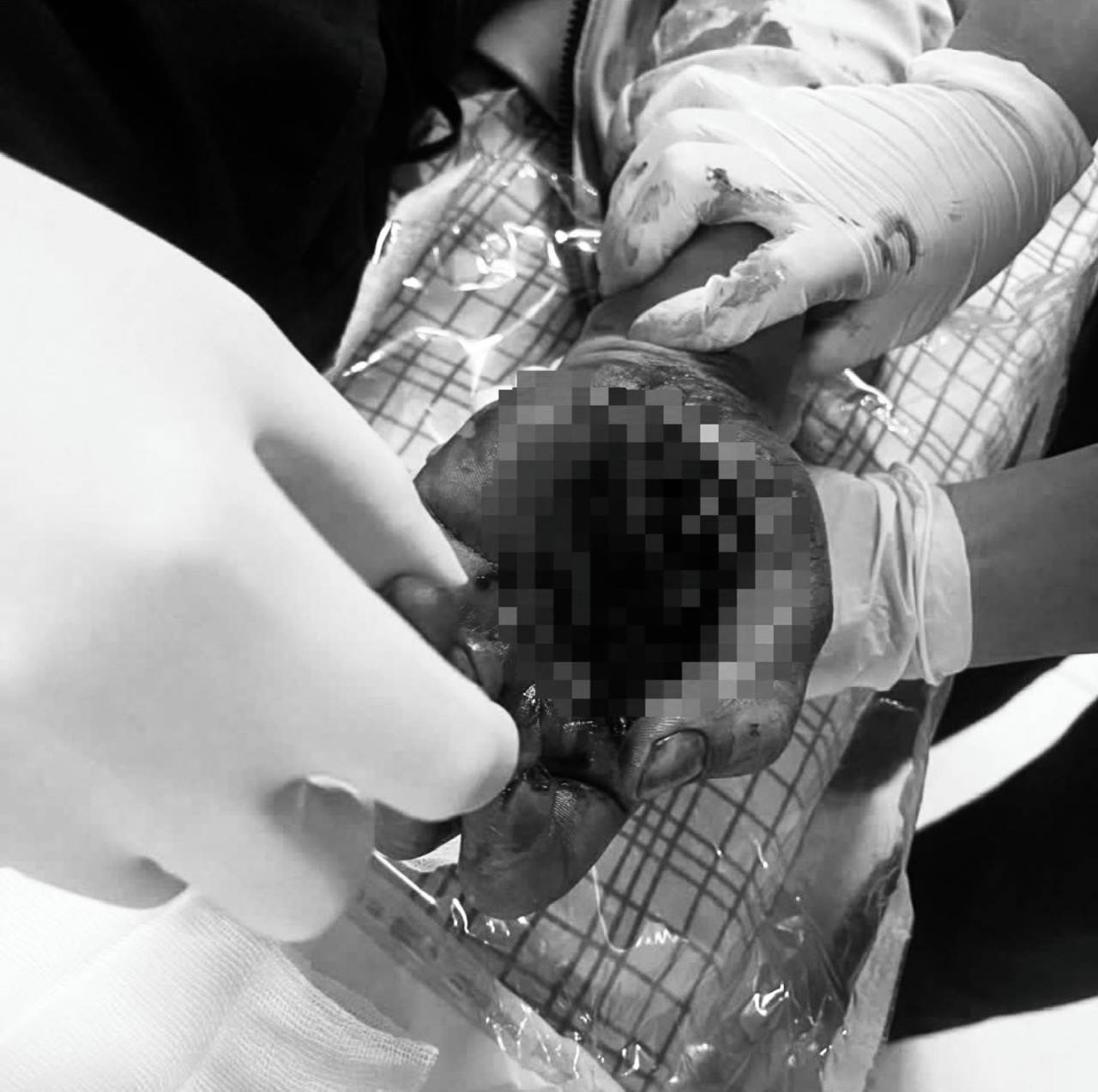 Firecrackers explode right in his hand, young man hospitalized with crushed hands. Photo: Thanh Xuan