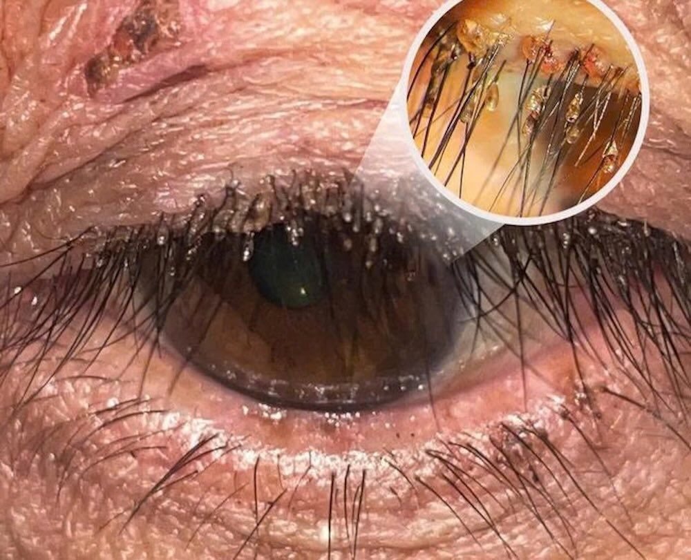 Under a microscope, doctors discovered pubic lice densely attached to the patient's eyelid. Photo: Hospital provided