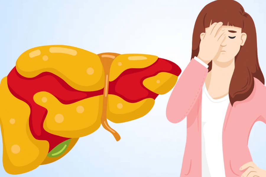 Fatty liver may be a sign that the retina is under pressure. Graphics: Thien Nhan