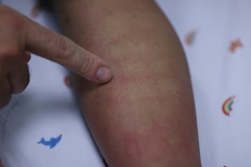 Sốt xuất huyết Dengue có triệu chứng khởi phát tương đồng với nhiều bệnh khác như cảm cúm, sốt siêu vi, khiến nhiều người dễ chủ quan, đến khám tại cơ sở y tế trong giai đoạn muộn. Nguồn ảnh: VGP