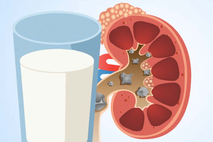 Boire du lait correctement aide à réduire le risque de calculs rénaux. Graphique: Thiện Nhân