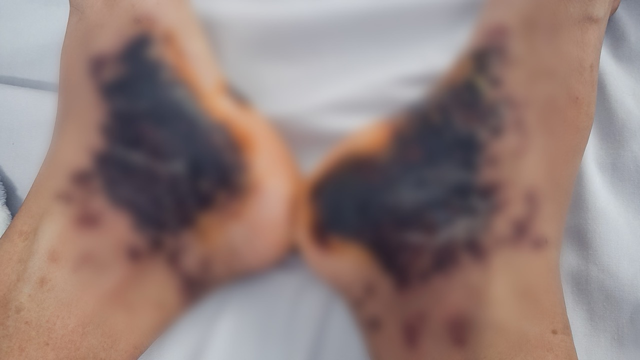 Seemingly simple skin lesions such as rash, bleeding in the leg need to be examined early for timely treatment. Photo: BVCC