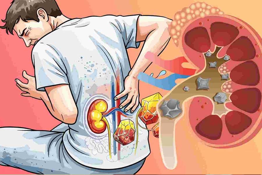 Men are at higher risk of kidney stones than women. Graphics: Hoang Khoi