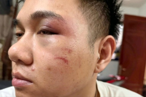 Hà Nội: Tài xế Grab bị khách say xỉn hành hung, sưng mặt mờ mắt. Ảnh nhân vật cung cấp