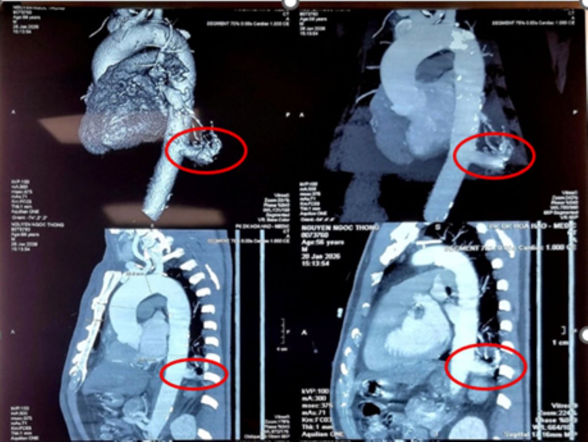 Binh Dan Hospital has just successfully performed surgery using a robot to treat end-tubular isolation of the lung (MSCT image of the patient's chest). Photo: Hospital provided