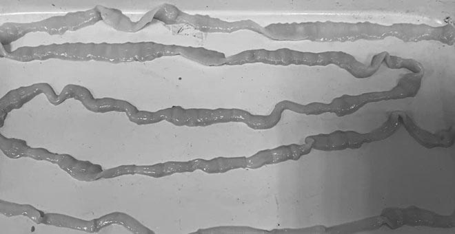 Image of a patient infected with 10m worms and tapeworms. Photo: Le Ha