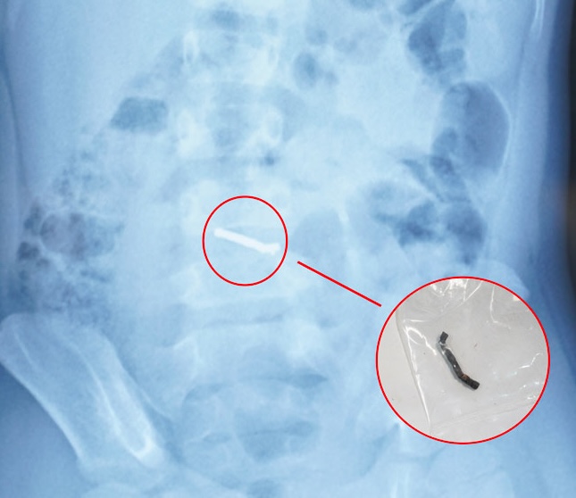 Hình ảnh nam châm trong bụng bệnh nhi được phát hiện khi chụp chiếu. Ảnh: BVCC