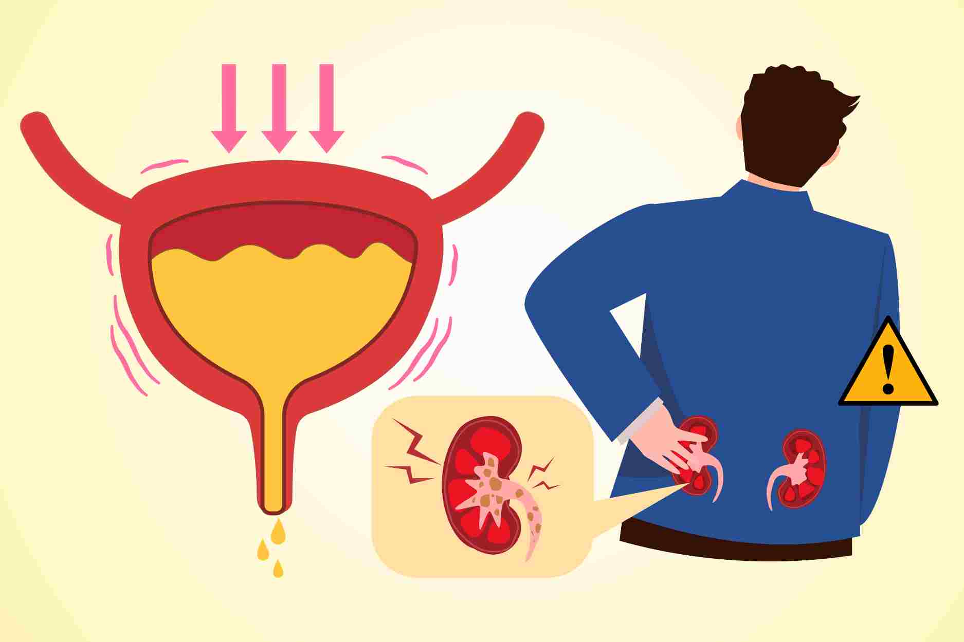 ¿Cómo cambia la orina cuando hay insuficiencia renal