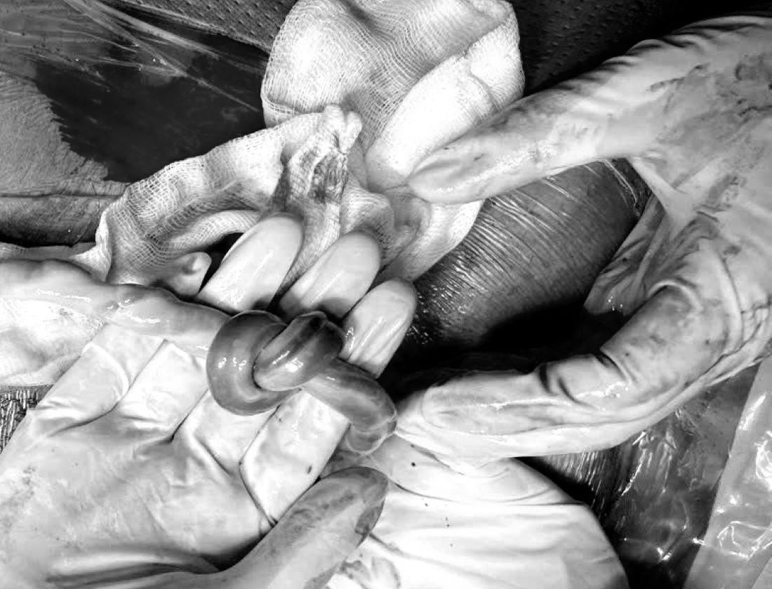 Cận cảnh dây rốn thắt nút sau phẫu thuật. Ảnh: Bệnh viện Quân y 121 