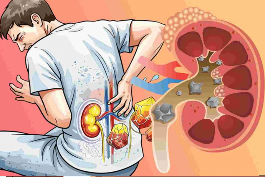 Los alimentos ricos en oxalato aumentan el riesgo de cálculos renales. Gráfico: Hoàng Khôi