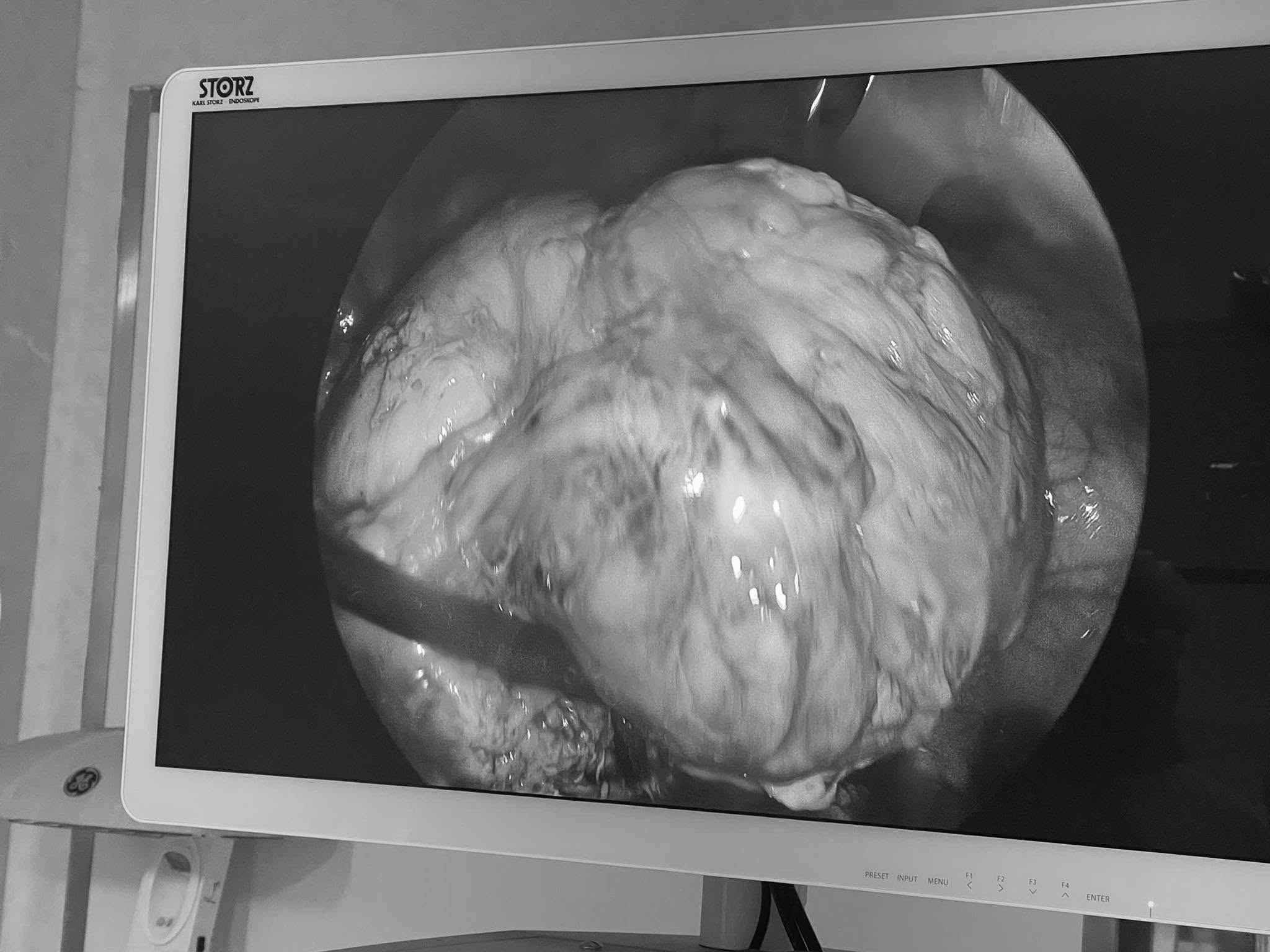 Almost lost motherhood due to giant uterine fibroids. Photo: BVCC