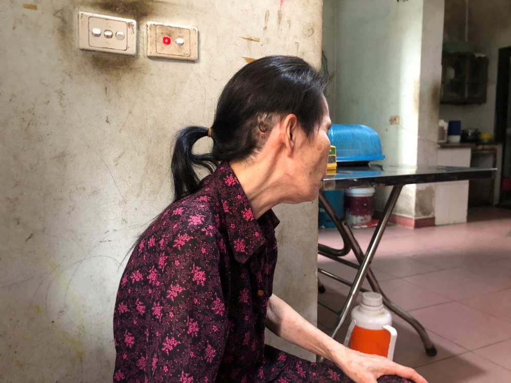 Ms. Nguyen Thi Huy and traces of 2 major surgeries that caused her health to decline. Photo: Quynh Chi