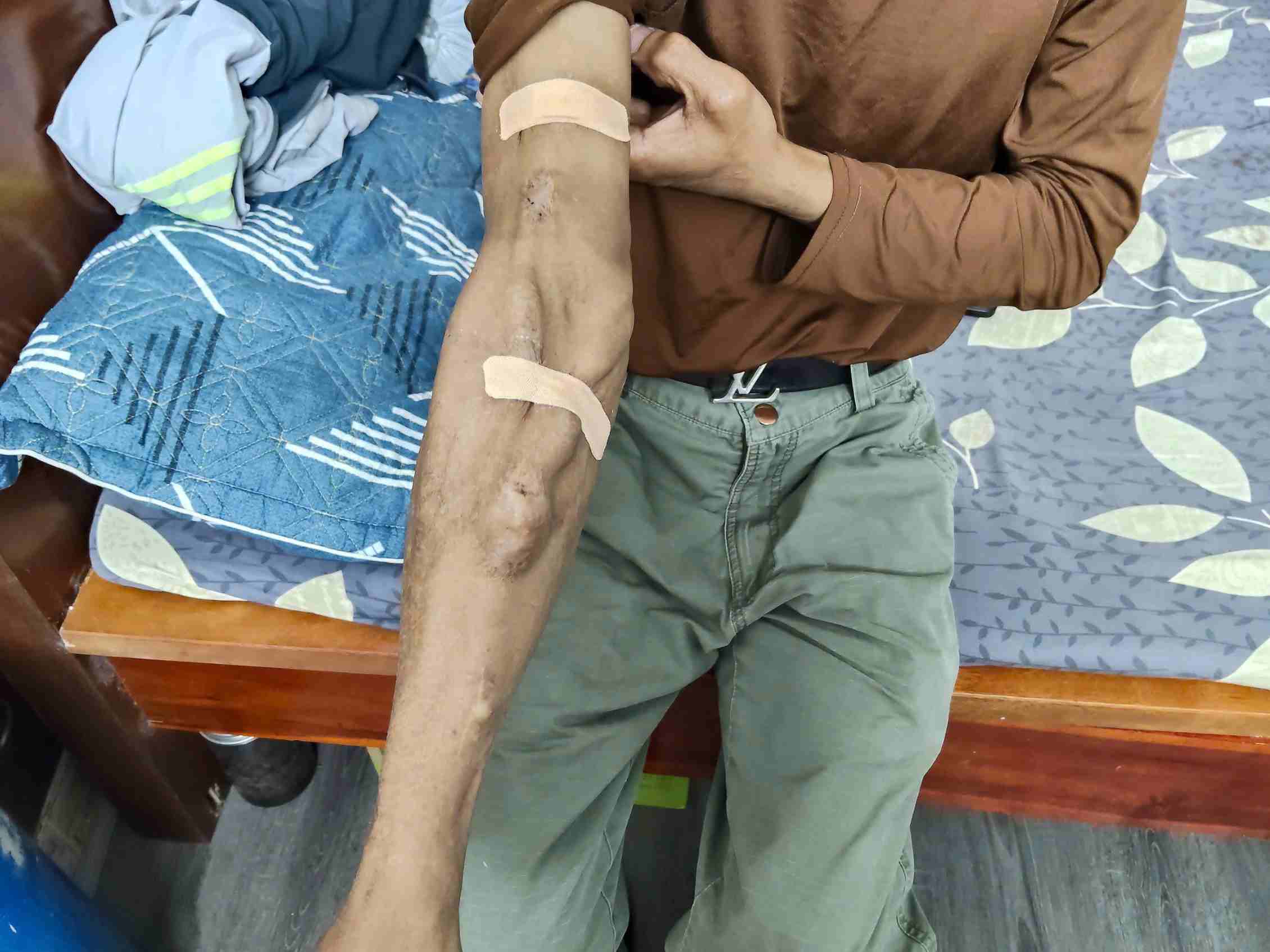 Những vết sưng trên tay anh Quyền là di chứng để lại của việc lọc máu liên tục trong suốt 30 năm qua. Ảnh: Thanh Trúc