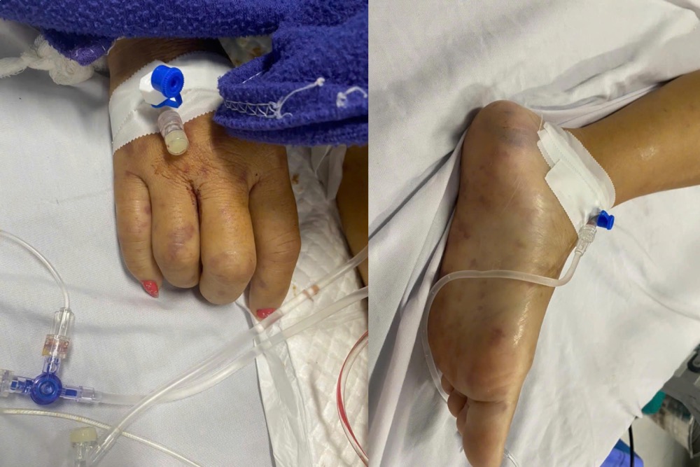 Trên cơ thể bệnh nhân xuất hiện nhiều ban xuất huyết, một số có hoại tử. Ảnh: BVCC. 