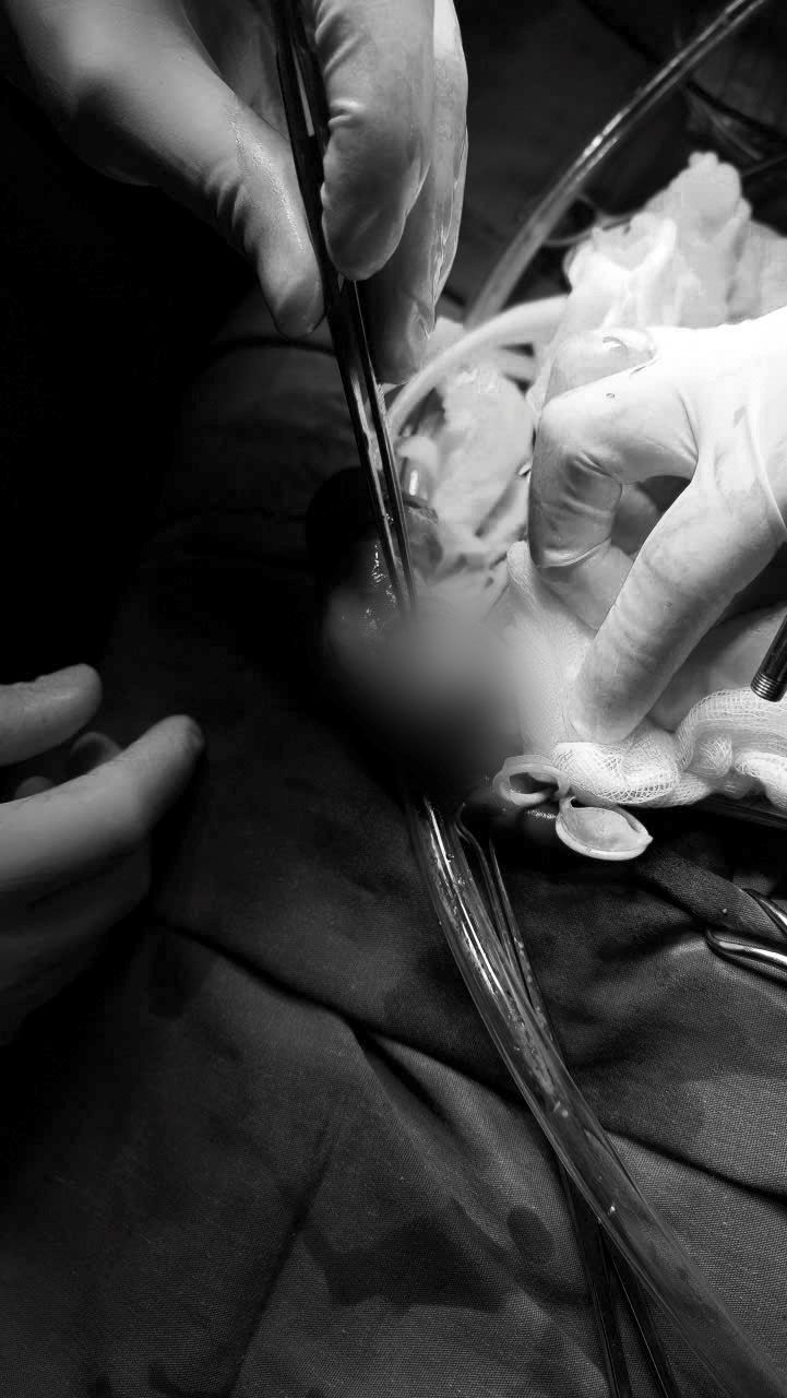 Hình ảnh phẫu thuật ca gãy dương vật. Ảnh: Bệnh viên cung cấp.