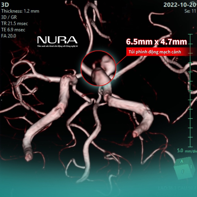 Hình động mạch cảnh trong được dựng hình chi tiết, cho phép bác sĩ nhìn rõ yếu tố đột quỵ tiềm ẩn. Ảnh: NURA Việt Nam
