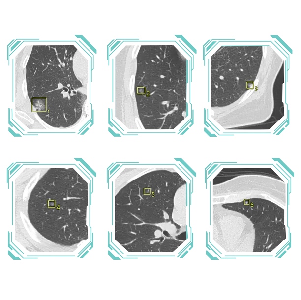 Lung images are automatically scanned by AI to cordon off each injured area by several millimeters, assessing cell density and the rate of suspected malignant risk. Photo: NURA Vietnam