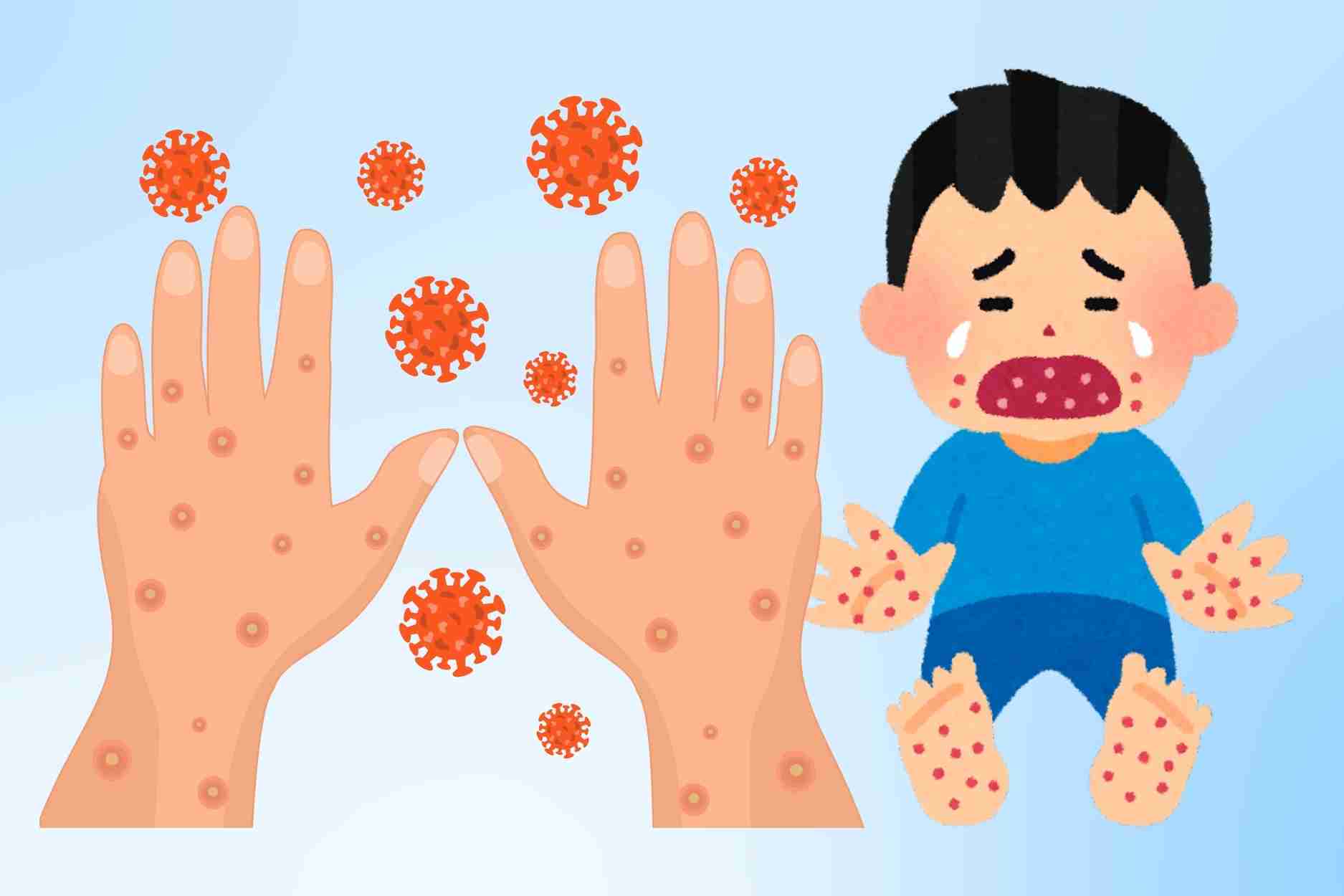 Hand, foot and mouth disease spreads quickly through 4 paths, many people are subjective
