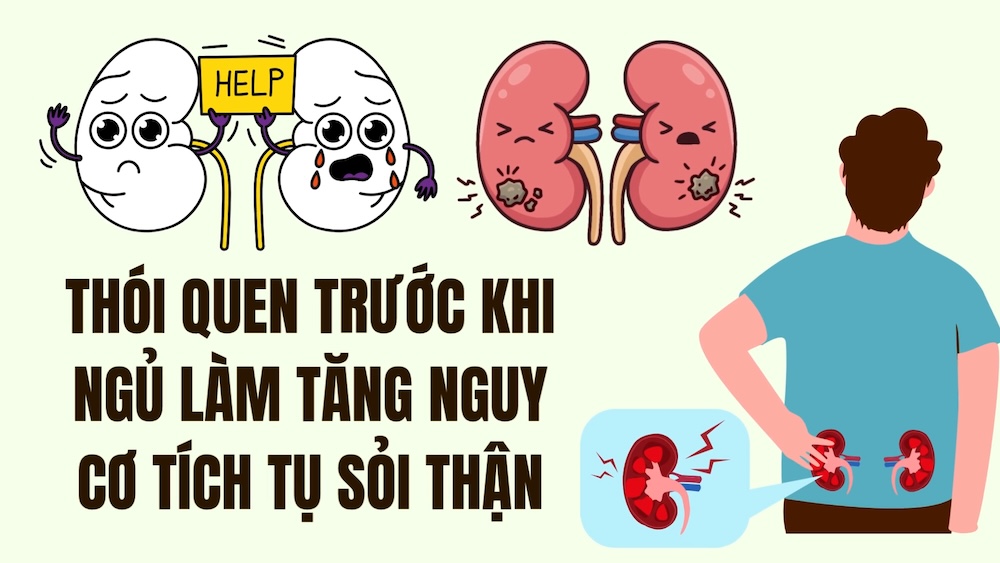 Bedtime habits increase the risk of kidney stones accumulating